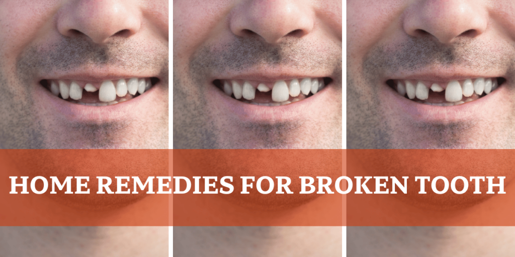 Home Remedies For Broken Tooth - Man with broken tooth