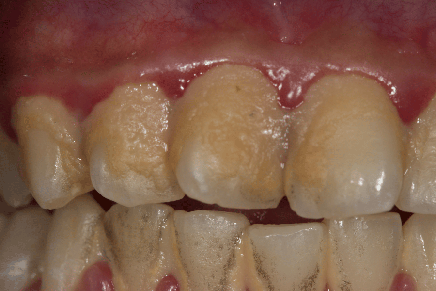 Plaque build up on teeth