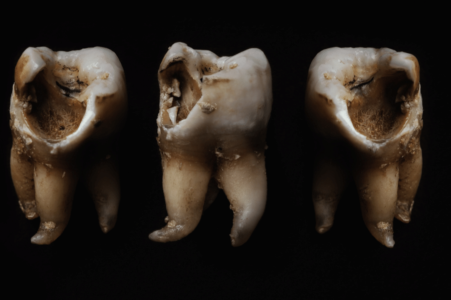 Decayed teeth